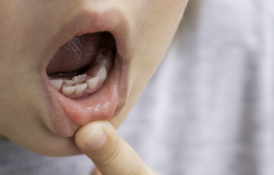 Plan Sur La Bouche D'un Enfant Ayant Une Double Rangée De Dents
